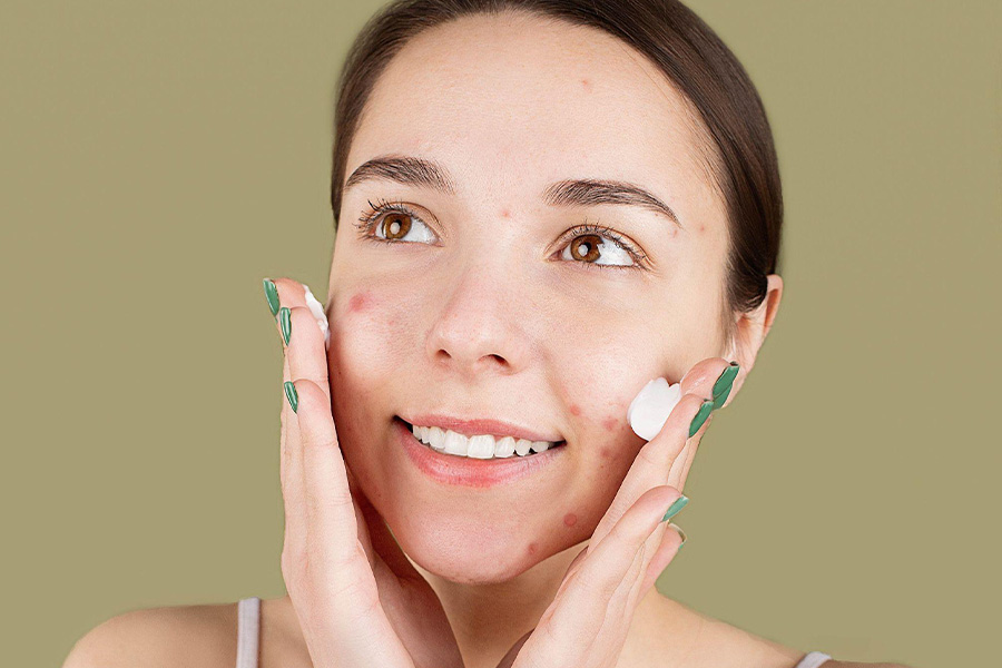 Woman with acne applying face cream
