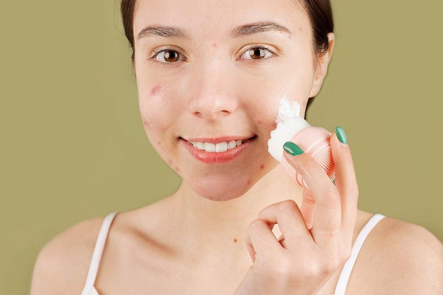 Teenager with acne applying beauty product